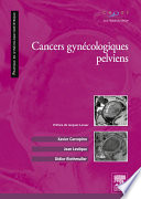 Cancers gynécologiques pelviens.