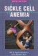 Sickle cell anemia /